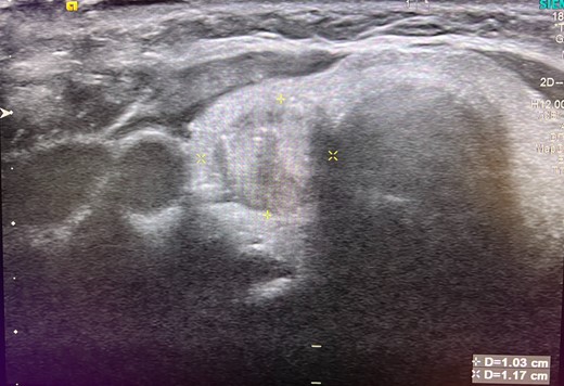 Ultrasound of the thyroid showing a 1.2 cm nodule of the right thyroid lobe.