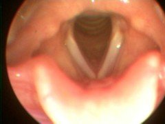 Normal Larynx