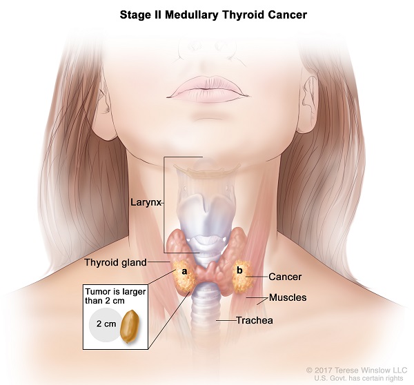 Medullary Thyroid