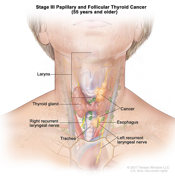 Papillary Follicular Thyroid