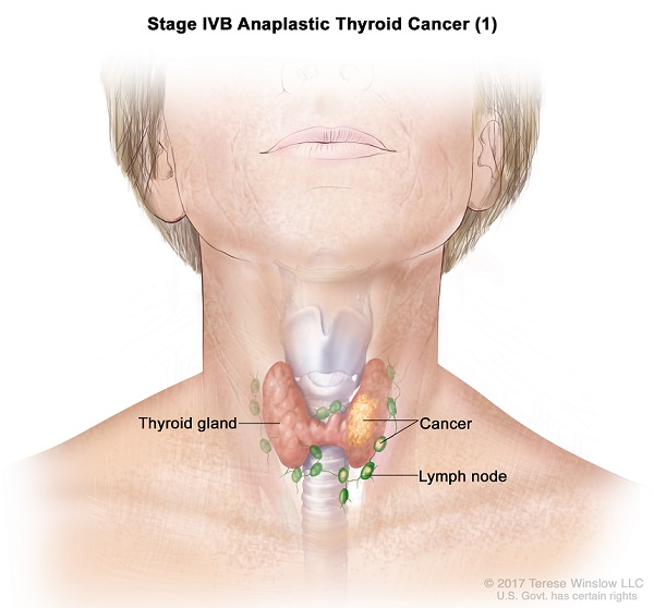 Anaplastic Thyroid