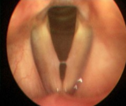 vocal fold nodule