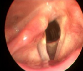 vocal fold paresis