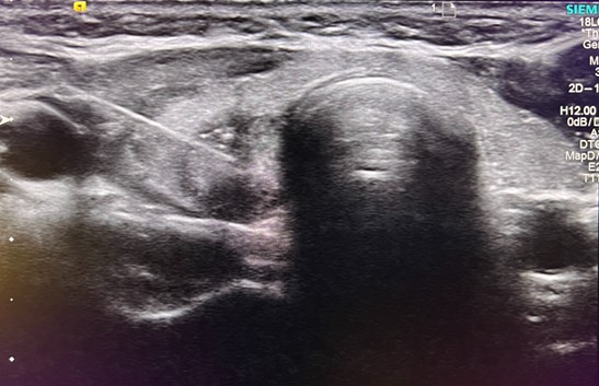 Ultrasound of the thyroid showing a 1.2 cm nodule of the right thyroid lobe.