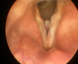 vocal fold polyps